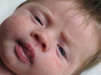Дерматит у немовляти: причини і способи лікування