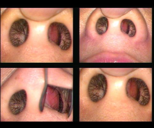 Викривлення носової перегородки: операція і лікування